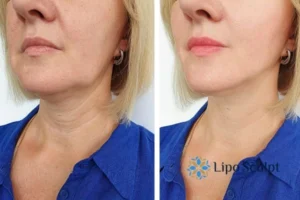 Double chin before and after Hi-Fu treatment 4 Book your double chin treatment Surrey today! We are here to help!