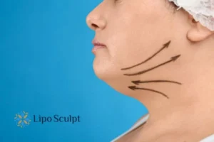 Double chin before and after Hi-Fu treatment 3 Boost your confidence with a Double chin treatment Surrey