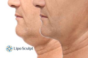 Double chin before and after Hi-Fu treatment 2 Double chin treatment Surrey from Lipo Sculpt - feel more confident today!