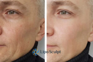 How to Fight Aging Symptoms 3 Fight Aging Symptoms Surrey With HIFU and Morpheus8 Today!