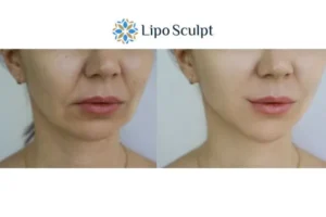 Explaining Total Skin Tightening Treatment And What It Can Do For You 2 Do you want to boost your self confidence? Give Morpheus8 Surrey a try today!