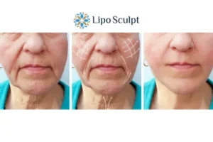 Explaining Total Skin Tightening Treatment And What It Can Do For You 3 Boost your confidence with Morpheus8 Surrey call our team today!