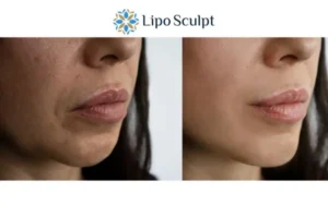 Explaining Total Skin Tightening Treatment And What It Can Do For You 4 Morpheus8 Surrey the best results - call our team today!