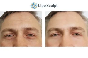 Explaining Total Skin Tightening Treatment And What It Can Do For You 6 Morpheus8 Surrey book in today to find out more!
