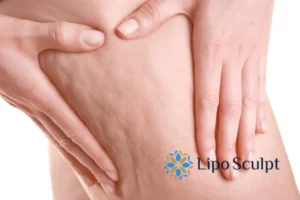 CoolSculpting for Legs: The Innovative Approach to Redefining Your Legs 5 Start your journey today book your coolsculpting treatment Surrey online today!