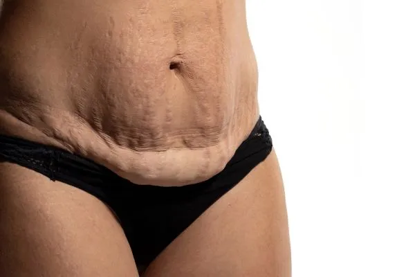 Lost the Weight but Not the Loose Skin? 1 image of womans stomach after weight loss showing loose skin Surrey